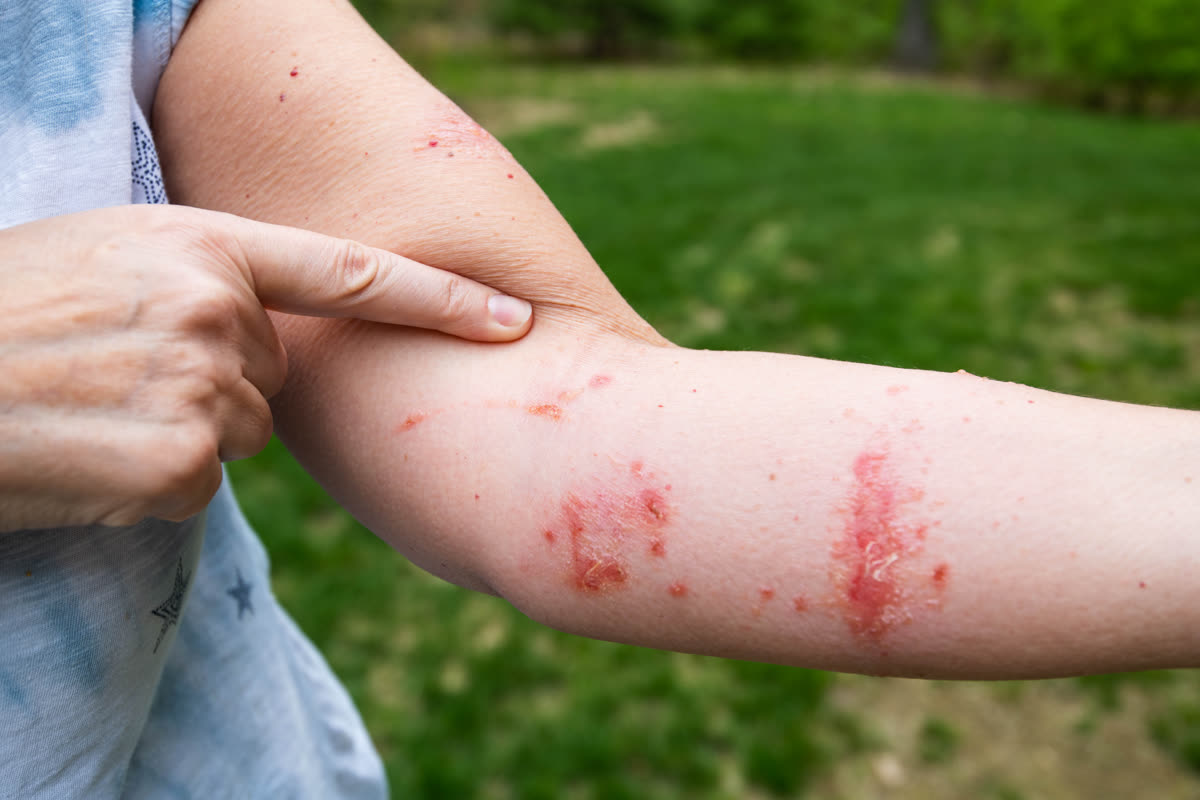 Blistering poison ivy rash on a forearm