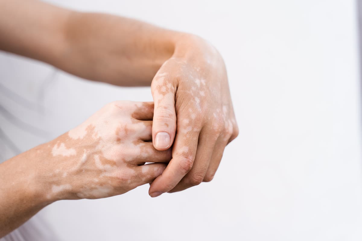 White vitiligo patches with well-defined edges on the hands